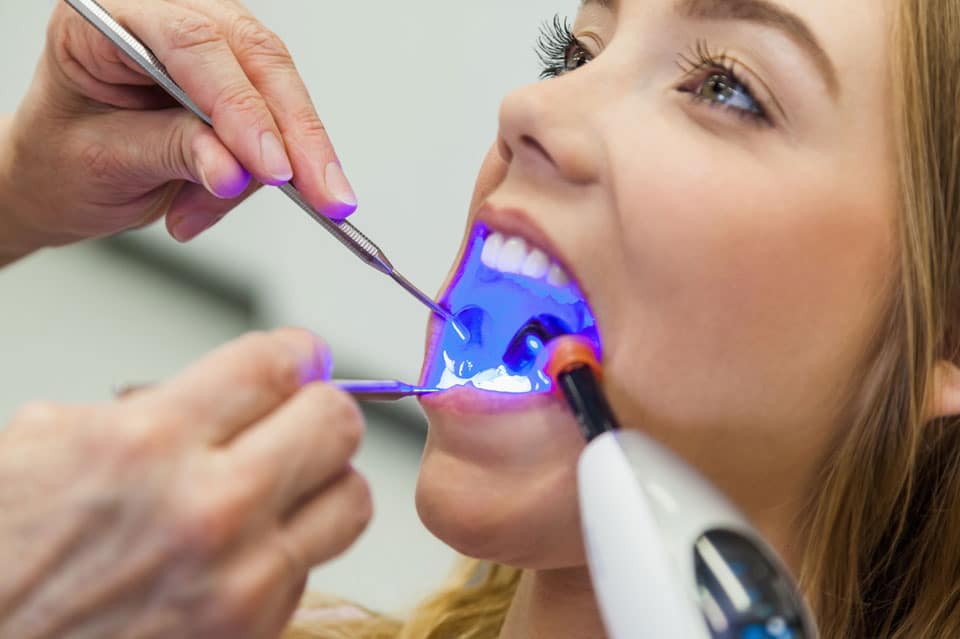 What Are The Aftercare Tips For Dental Filling?