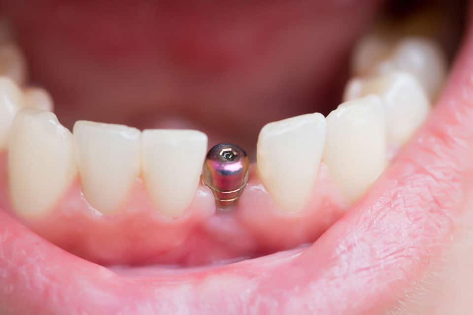 Dental Implant near me